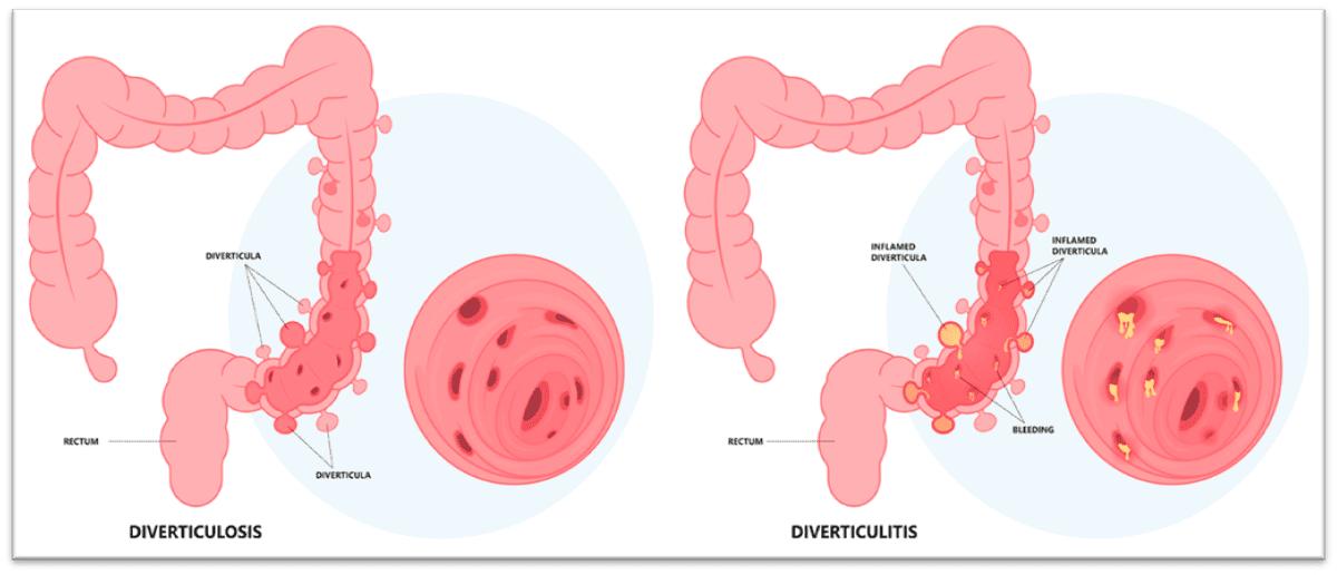 Diverticulitis, diverticulosis, flare up, diverticulitis flare up