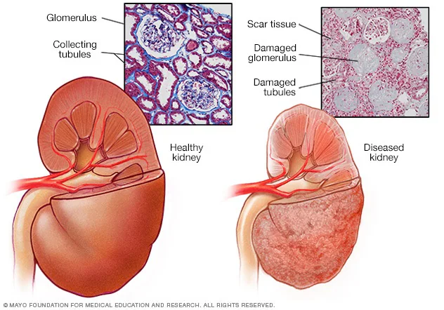 Kidney disease, kidney, polycystic kidney disease, chronic kidney disease, dialysis, haemodyalisis